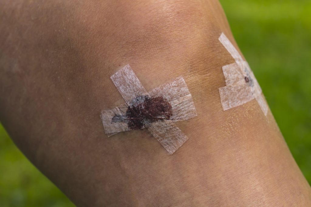 cerotti post operatori